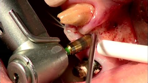 ASTRA TECH Implant System - Case 24 - YouTube