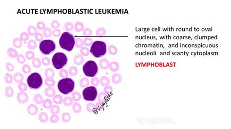 Peripheral smear findings in Leukemia - Illustrated - Pathology Made Simple