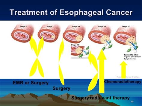 11 esophageal cancer