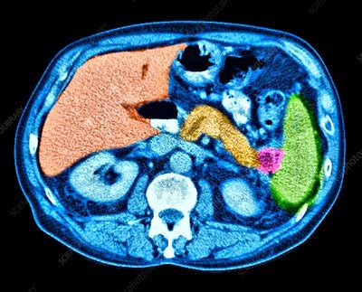 Pancreatic cancer, CT scan - Stock Image - C037/8292 - Science Photo Library