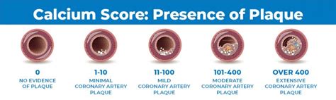 Advanced Radiology Consultants: Coronary Artery Calcium Scoring