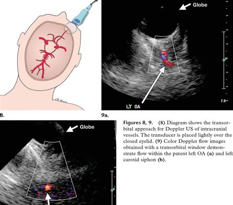 Figure 4 from Advances in transcranial Doppler US: imaging ahead. - Semantic Scholar | Figures ...