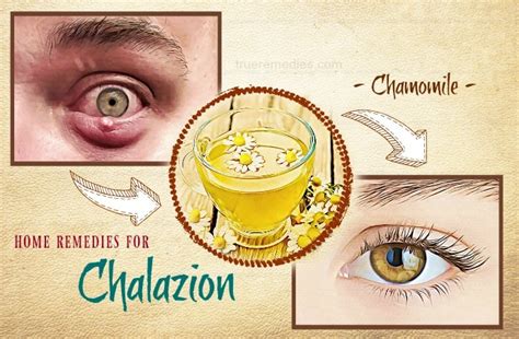 38 Natural Home Remedies For Chalazion Cysts On The Eyelid