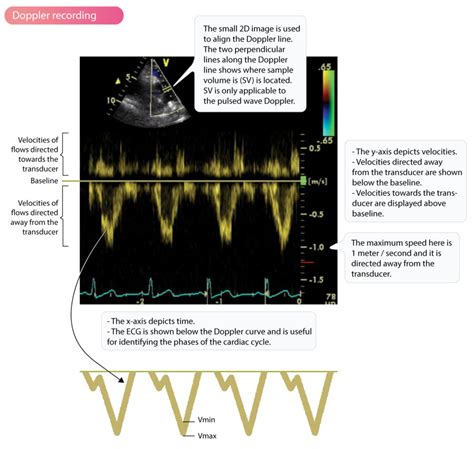 Doppler effect and Doppler echocardiography – Cardiovascular Education