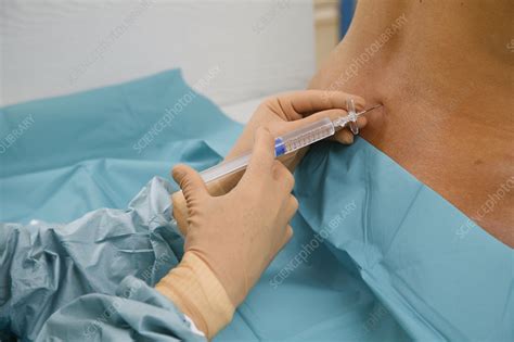 Epidural anesthesia - Stock Image - C006/3338 - Science Photo Library