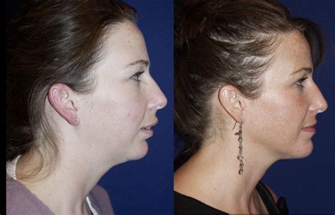 Genioplasty Surgery in Pune | Chin augmentation, Facial surgery, Types of plastic surgery