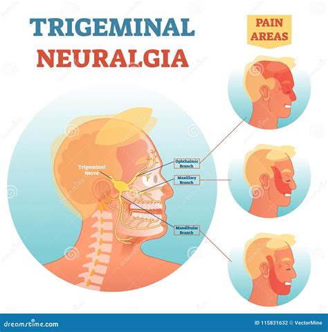 Trigeminal Neuralgia Medical Cross Section Anatomy Vector Illustration ...