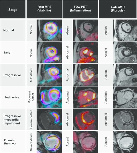 Staging of cardiac sarcoidosis using resting myocardial perfusion ...