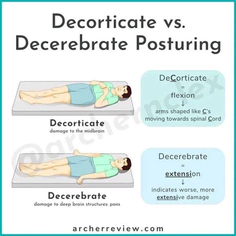 Decorticate vs. Decerebrate Posturing Flashcards | Quizlet