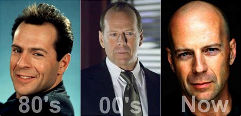 Bruce Willis Hair Transplant Results - Anastasakis Hair Clinic