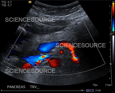 Normal pancreas, ultrasound | Stock Image - Science Source Images