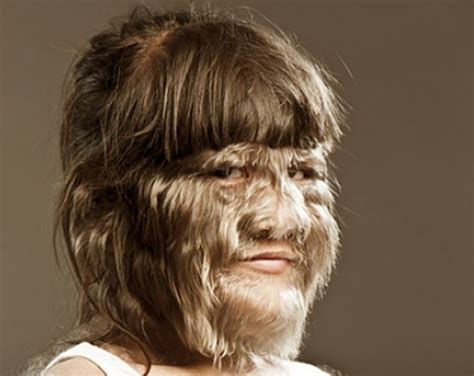 Hypertrichosis - Symptoms, Causes, Treatment, Pictures