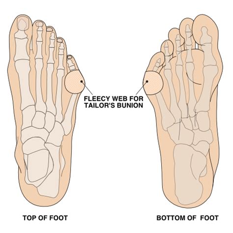 Tailor's Bunion And Bunion On Same Foot Online | emergencydentistry.com