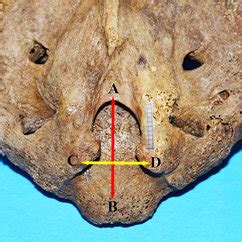 Anatomy of the sacral hiatus and its clinical relevance in caudal ...