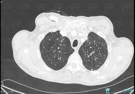 Radiology case : Centrilobular emphysema (CT) - Diagnologic