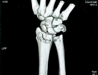 Ct scan right wrist joint 3d view shows right distal radius fracture • wall stickers x-ray ...
