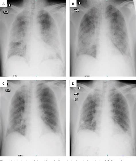 Figure 1 from Pulmonary Rehabilitation of a Critically Ill Patient with Severe COVID-19: A Case ...