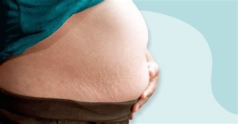 What Is a B Belly During Pregnancy and Why Does It Happen?