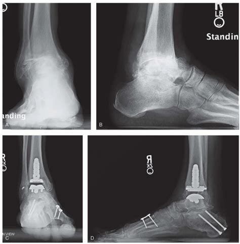 Cavovarus Deformity | Musculoskeletal Key