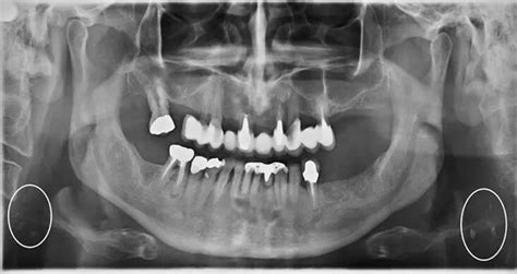 Cone beam CT may incidentally detect calcified head-and-neck atheromas during dental evaluation