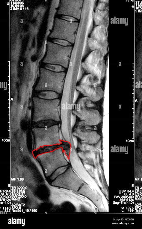 MRI scan clearly showing a slipped disc pressing on the spinal cord with the affected area ...