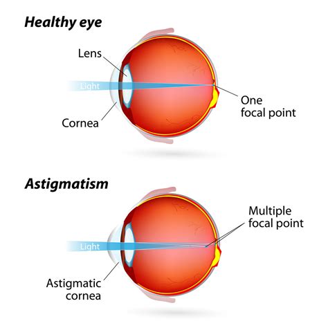 Astigmatism | Eye Patient