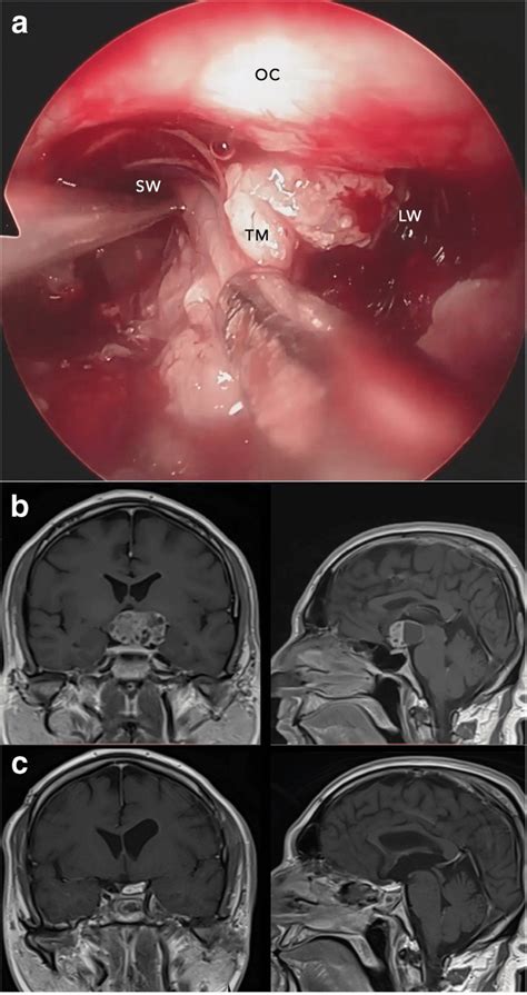 a Endoscopic view dissection of the tumor from optic chiasm and... | Download Scientific Diagram