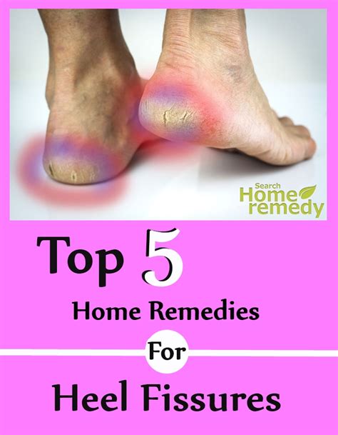 Top Five Home Remedies For Heel Fissures | Search Home Remedy