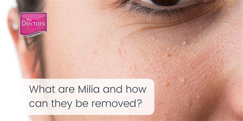 Milia Removal Norwich - Expert Laser Treatment