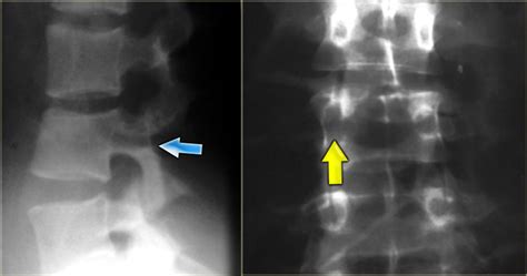 Chance Fracture - Medicalopedia