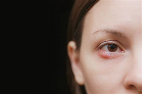 Chalazion: Symptoms, Causes, Treatments & More | MyVision.org