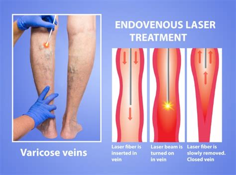 Varicose Veins Treatment In Phoenix AZ | Laser Vascular Center