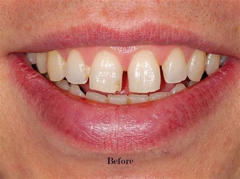 Before/After - Tooth Gaps - YouTube