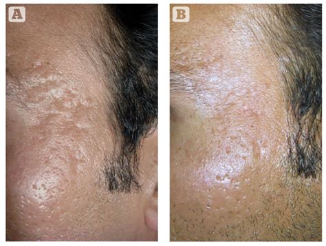 Microneedling and its applications in dermatology | PRIME Journal