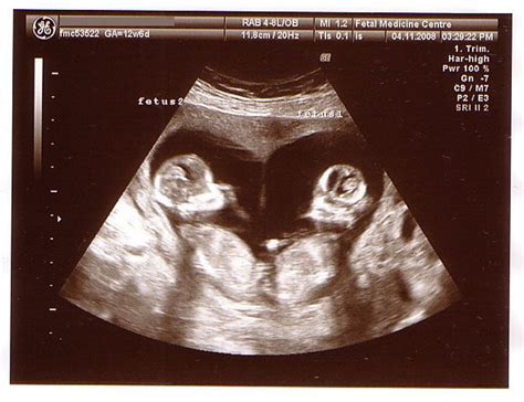 Twins - 12 Week Scan (Heart shaped) | Baby ultrasound pictures, Baby ultrasound, Twin baby boys