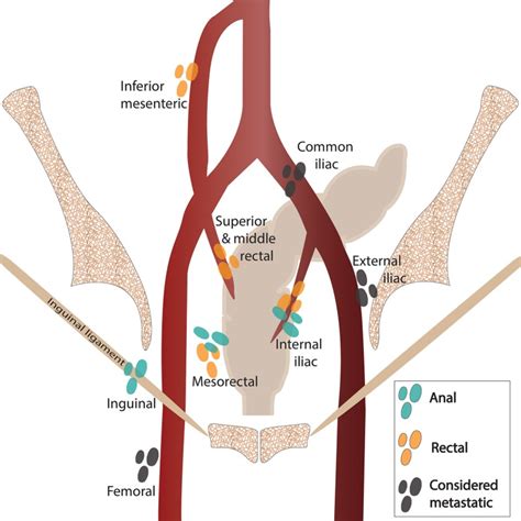 Radiotherapy Dictionary: Regional lymph nodes in rectal cancer