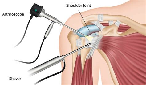 Shoulder arthroscopy procedure, anatomy, recovery time & rehab protocol