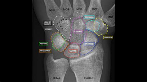 Wrist X-ray Interpretation - OSCE Guide | Geeky Medics