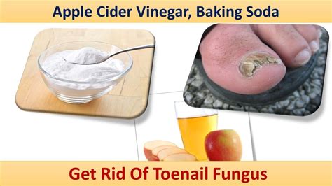 Apple Cider Vinegar And Baking Soda For Toenail Fungus / Toenail Fungus Treatment | Baking Soda ...