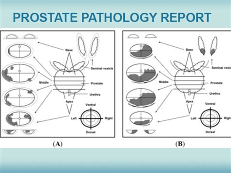 Understand Your Prostate Pathology Report - CancerConnect