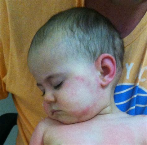 Baby Egg Allergy Rash Pictures - Get More Anythink's