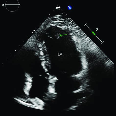 Echocardiography modified 4-chamber view showed large left ventricular ...