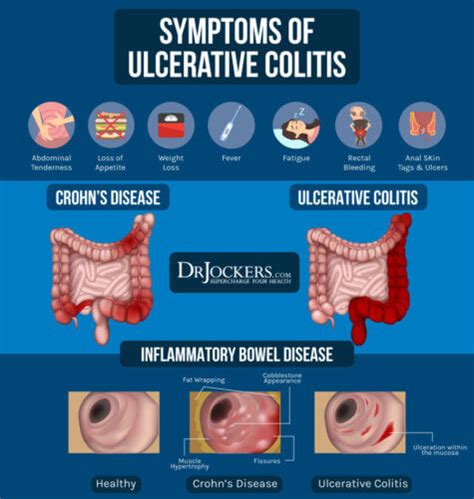 Ulcerative Colitis: Causes, Symptoms and Support Strategies