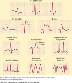 10 Best QRS Complex ideas | qrs complex, cardiac nursing, ekg