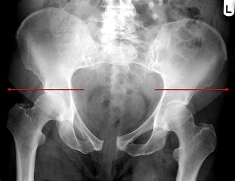 Pelvic Fracture X Ray