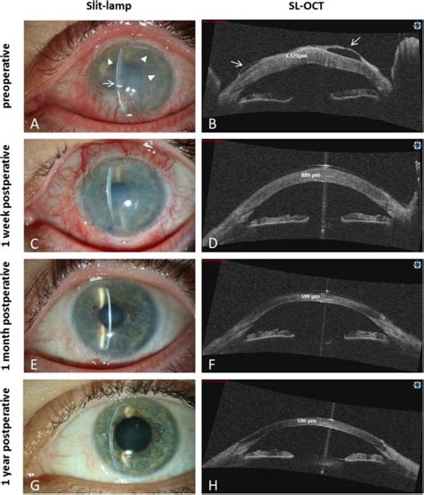 Treatment of corneal edema secondary to chemical burn by Descemet ...