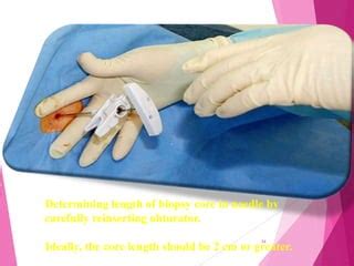 Bone marrow aspiration & trephine biopsy