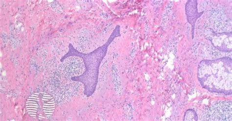 DermNet® - Folliculosebaceous cystic hamartoma histology image