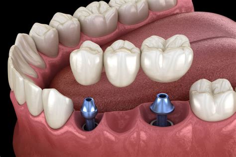 Dental Implant Surgery | Boston, MA | Stuparich & Nouel