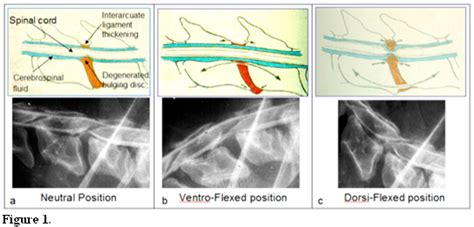 Pathogenesis and Diagnosis - Wobbler Syndrome: